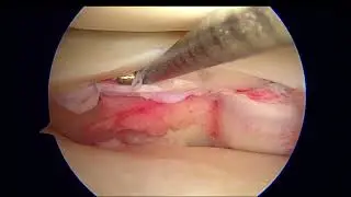 Lateral Meniscus Repair of Left Knee Bucket Tear and Radial Tear