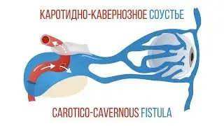 Каротидно кавернозное соустье / Carotico-cavernous fistula