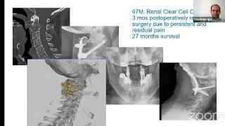 Metastatic Disease of the Cervical Spine