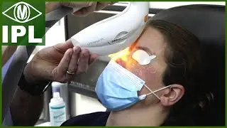 IPL Treatment for Dry Eye (Intense Pulsed Light Therapy)