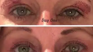 Eye lift without surgery what?!