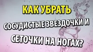 Сосудистые звездочки и сеточки на ногах. Как убрать