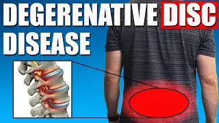 DEGENERATIVE DISC DISEASE (DDD).  BEST Exercises, Stretches & Advice for Back Pain Relief