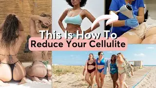 Trying Everything for Cellulite? See What EmTone Can Do!