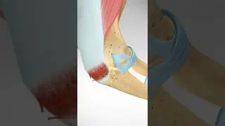 Triceps Tendon Avulsion and Surgical Repair 