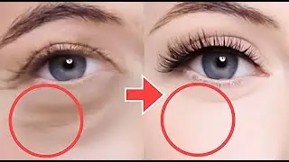 Eye Lifting Massage For Eye Bags, Eye Wrinkles, Dark Circles Under Eyes, Droopy Eyelids, Bigger Eye