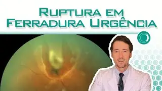 Ruptura da retina em ferradura = URGÊNCIA !!