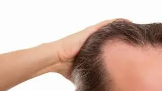 Is Ketoconazole Good For Hair