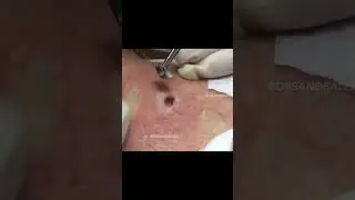 Dr Pimple Popper vs Blackheads on Back! 
