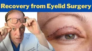 How to Recover from a Blepharoplasty | Plastic Surgeon's Guidance on Eyelid Surgery Recovery