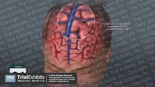 Cortical Vein and Superior Sagittal Sinus Thrombosis