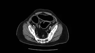 Colon cancer with small bowel obstruction