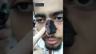 Easily remove Blackheads White Heads etc 