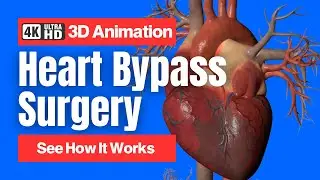 Heart Bypass Surgery - See How It Works - 3D Animation (Coronary Artery Bypass Graft CABG)