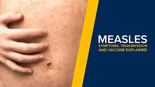 Measles - Symptoms, Transmission and Treatment Explained By a Doctor