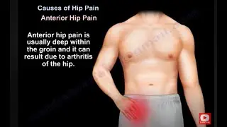 Hip pain -  Why does  it hurts? What causes the pain?  How is it treated ? is it hip arthritis?