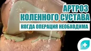 Артроз коленного сустава: когда операция необходима?