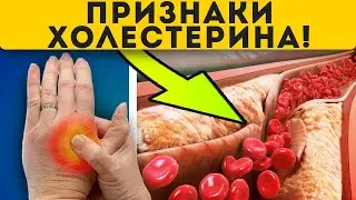 Вот как понять о повышении холестерина!