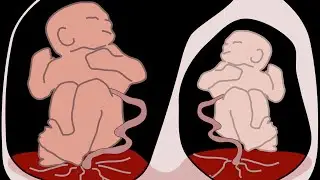 MNEMONIC - Complications of Multiple Gestation!