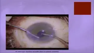 AIOC2018 - GP049 - VAST Session  Cataract - Dr.Suvira Jain