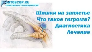 ГИГРОМА ЗАПЯСТЬЯ. ЧТО ЭТО И КАК ЛЕЧИТЬ?