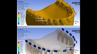 Pulling the Sides of an Orthodontic Archwire from Dental Braces  - ANSYS Workbench Explicit Dynamics