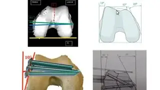 Distal Femur Fractures