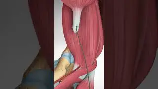 Distal Biceps Tendon Rupture and Repair  #bicepstendon #elbowpain #biceps