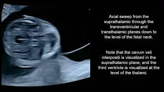 The prevalence and evolution during the first-trimester of the cavum veli interpositi