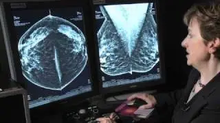 Innovations In Breast Cancer Detection: 3D Mammography