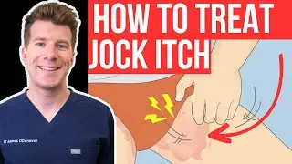 Doctor explains how to RECOGNISE AND TREAT JOCK ITCH (aka Tinea Cruris or Ringworm of the groin)...