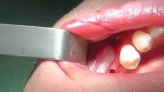 MMdental Gniezno - Zabieg implantacji