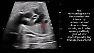 Ultrasonographic features & postnatal management of giant aneurysm of the left atrial appendage