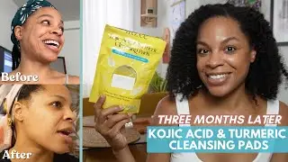 Kojic Acid and Turmeric Cleansing Pads THREE MONTH UPDATE Before & After | My Full Skincare Routine