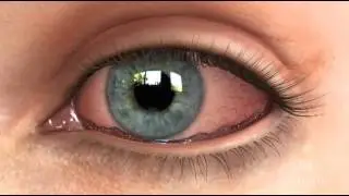 Conjunctivochalasis (CCH) Dry Eye Animation