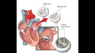 Artificial Heart Valves