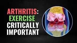 Knee Arthritis? Your Lack of Exercise could be the Culprit