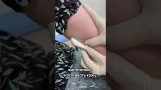 Установка импланона за 1 минуту от гинеколога высшей категории Наиды Рамазановны ✨