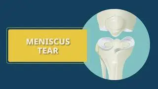 Meniscus Tear