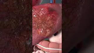 Watch What Happens To Your Body When You Use Steroids