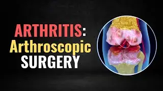 The Hidden Dangers of Arthroscopic Surgery for Knee Arthritis