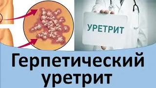 Герпетический уретрит