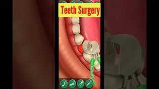 Teeth surgery 3D Animation #shortvideo #shorts #dental #3d