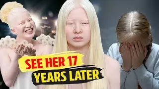 See How A Girl Who Was Abandoned Because Of Albinism Became A Model After 17 Years?