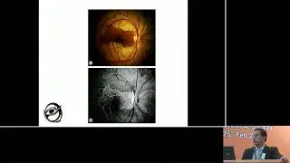 AIOC2018 - IC239 - Topic - central retinal artery occlusion..