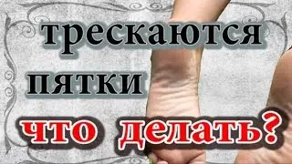 Почему трескаются пятки.  Что делать?