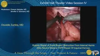 Robotic Repair of Small Bowel Obstruction From Internal Hernia After...