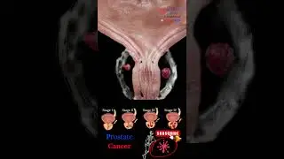 Prostate CAncer 🩺 3D Animation 📽 Medical Arts 