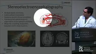 Stereoelectroencephalography (SEEG) - Carter S. Gerard, MD