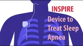 INSPIRE Device to Treat Sleep Apnea